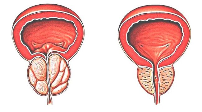 Prostatite e próstata normal