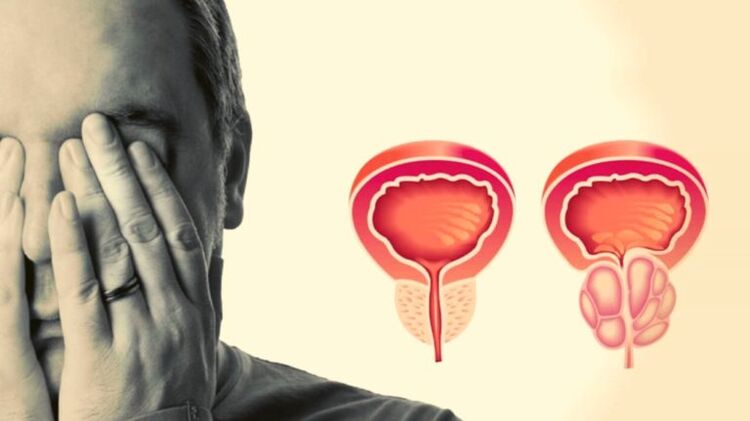 Un home ten prostatite