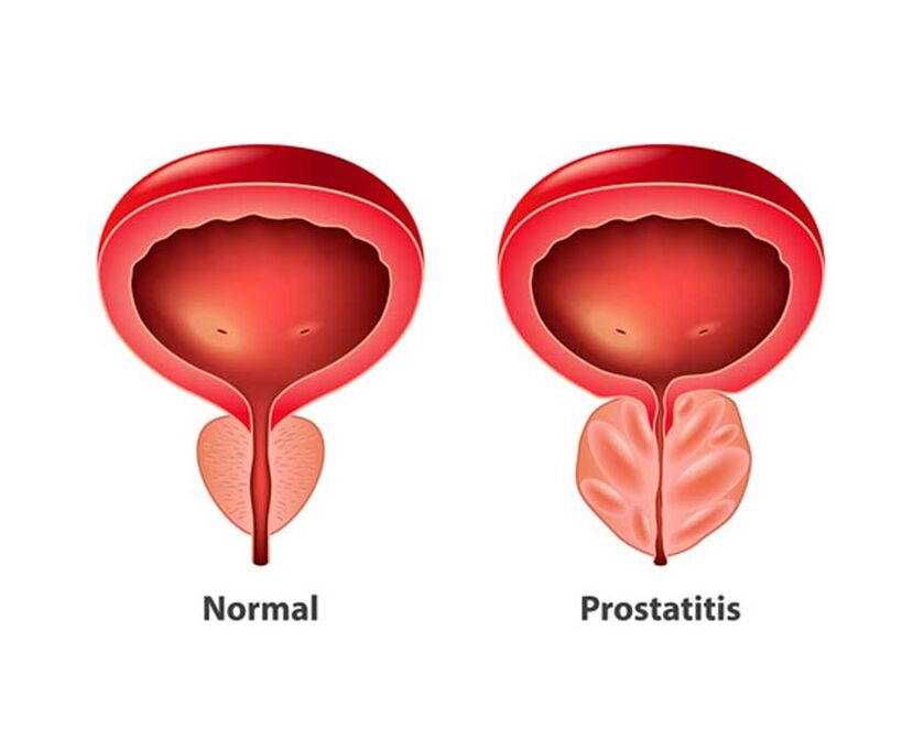 próstata normal e inflamatoria